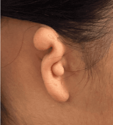 Clinical example of microtia showing underdeveloped external ear